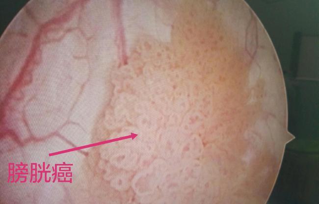 膀胱癌早期是什么癥狀,膀胱癌早期是什么癥狀會死人嗎