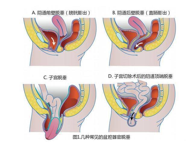 子宮下垂的癥狀(子宮下垂的癥狀動畫)