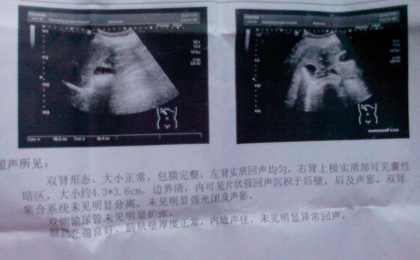 腎囊腫癥狀(腎囊腫癥狀疼痛部位用手壓住就不疼了)