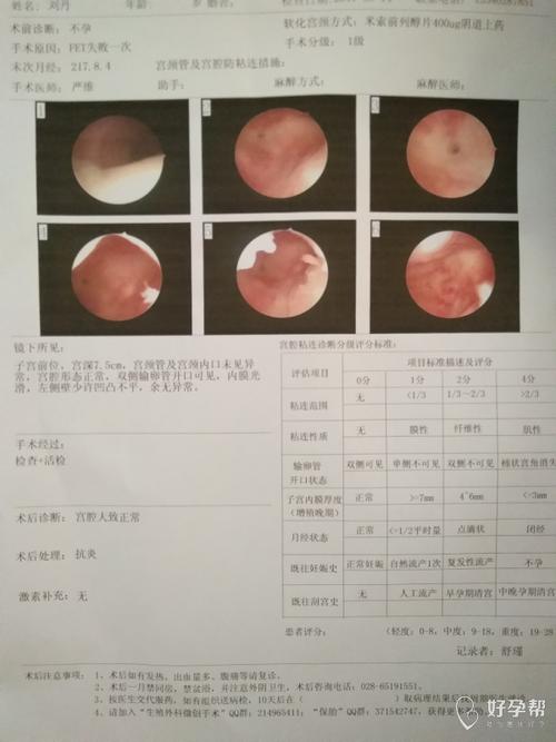 害怕宮腔鏡手術(shù)副作用-做宮腔鏡手術(shù)副作用