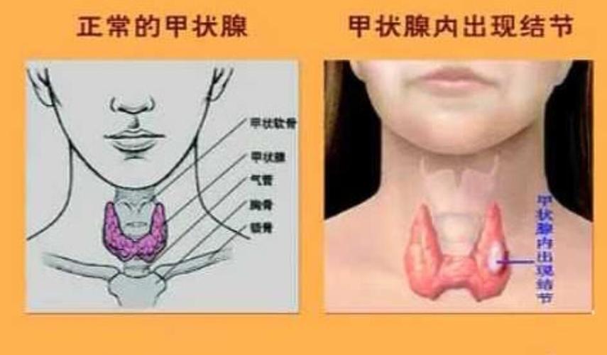 甲狀腺癌癥狀(甲狀腺癌癥狀圖片)