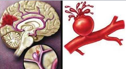腦血管痙攣癥狀,腦血管痙攣癥狀是什么引起的