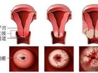重度宮頸糜爛的癥狀_重度宮頸糜爛的癥狀有哪些圖片